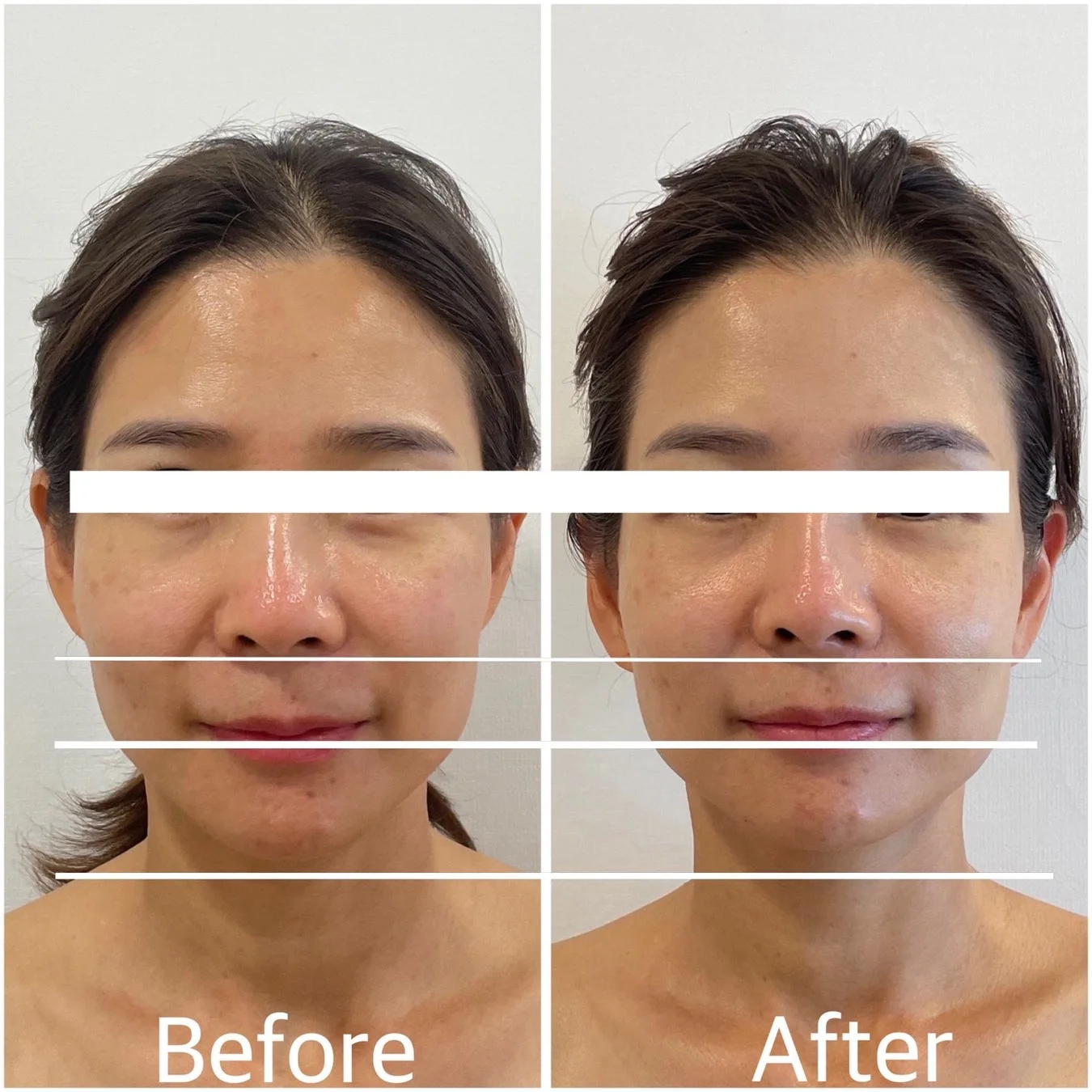 中顔面短縮Before/After